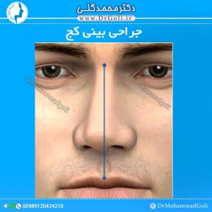 جراحی بینی کج
