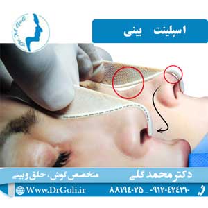 جراحی بینی طبیعی