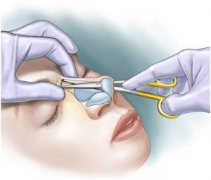 روش جراحی بینی بسته