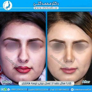 توصیه های مهم قبل و بعد از جراحی بینی
