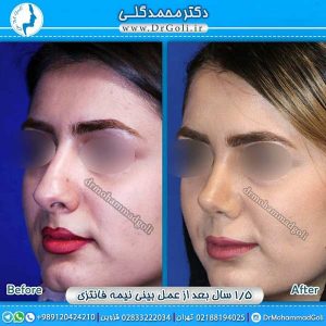 توصیه های مهم قبل و بعد از جراحی بینی