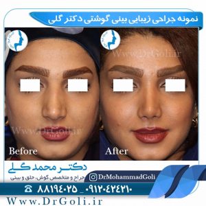 ارزیابی قبل از جراحی زیبایی بینی