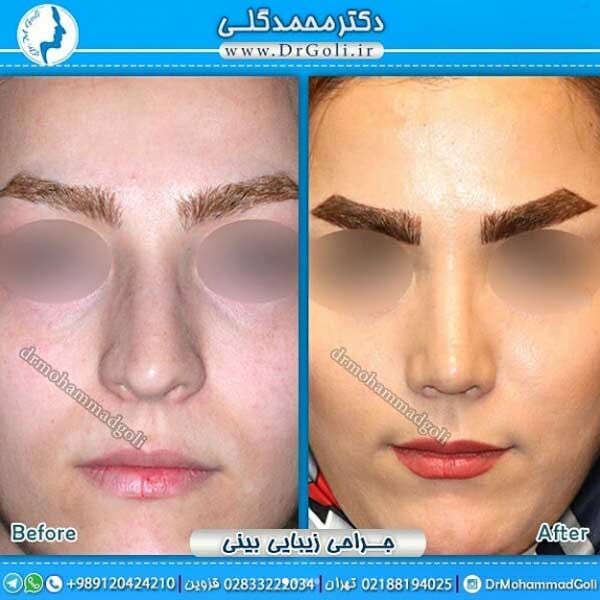 جراحی بینی استخوانی