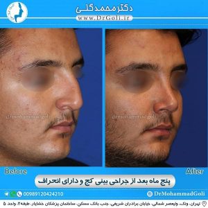 جراحی بینی کج