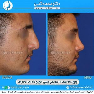 جراحی بینی کج