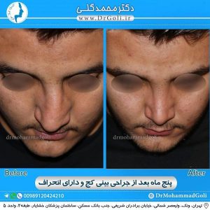 جراحی بینی کج