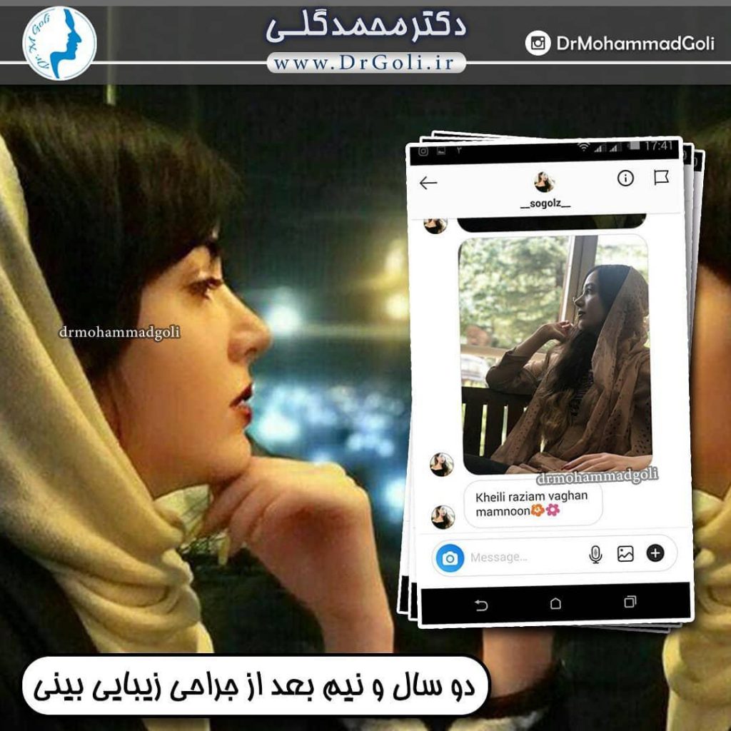 آبریزش بینی بعد از عمل بینی