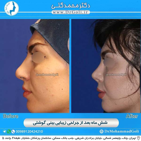 جراحی بینی گوشتی