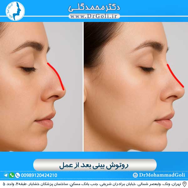 روتوش بینی بعد از عمل 