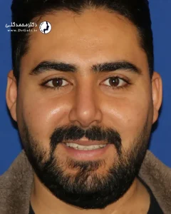 جراحی بینی مردانه در تهران