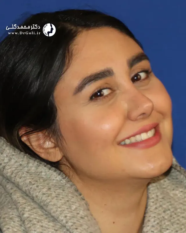 عمل بینی در تهران - دکتر محمد گلی