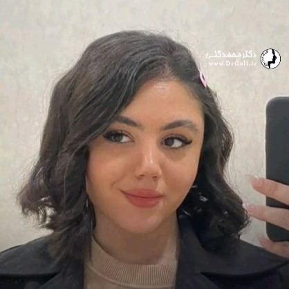 عکس جراحی بینی در تهران