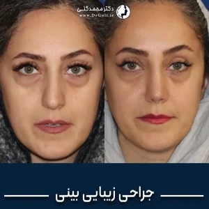 جراحی زیبایی بینی
