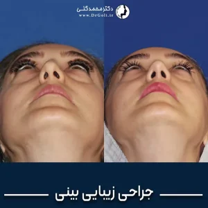 رینوپلاستی در تهران