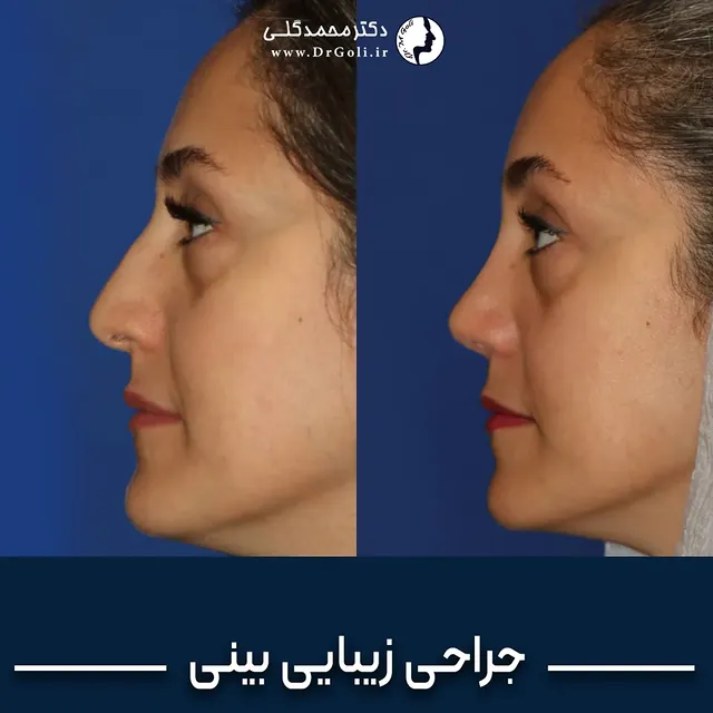 جراحی بینی - دکتر محمد گلی