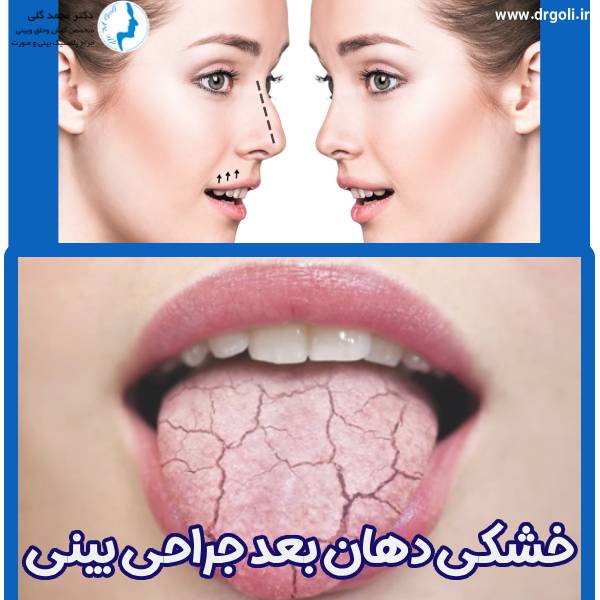 خشکی دهان بعد از جراحی بینی - دکتر محمد گلی