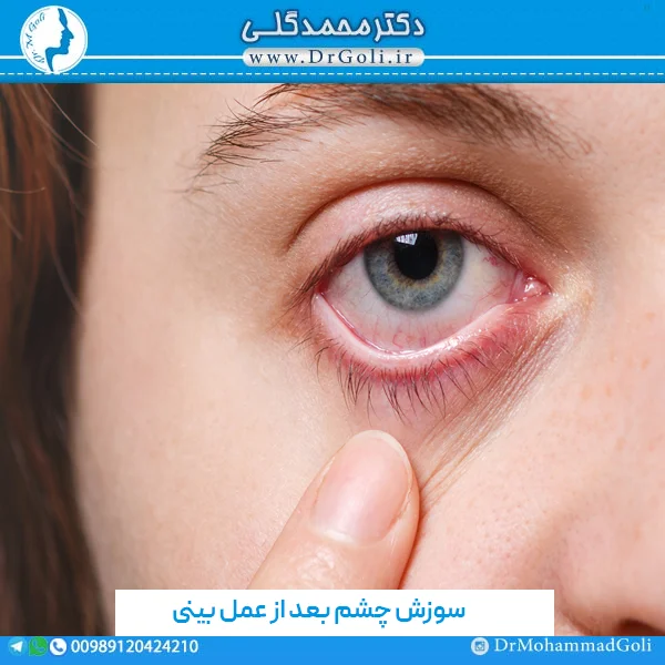 سوزش چشم بعد از عمل بینی - دکتر گلی