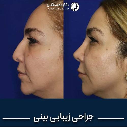 جراحی-زیبایی-بینی-925