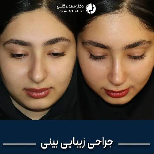 جراحی-زیبایی-بینی-926