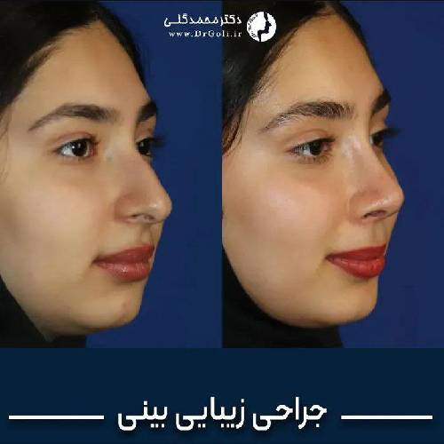 جراحی-زیبایی-بینی-927