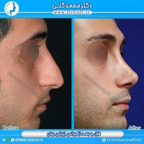 جراحی-زیبایی-بینی-1