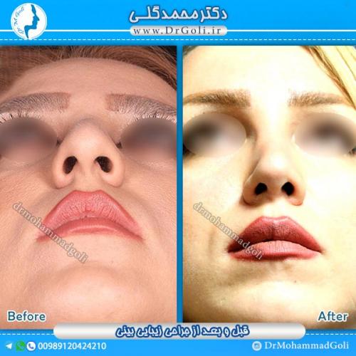 جراحی-زیبایی-بینی-10