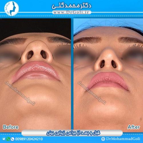 جراحی-زیبایی-بینی-11