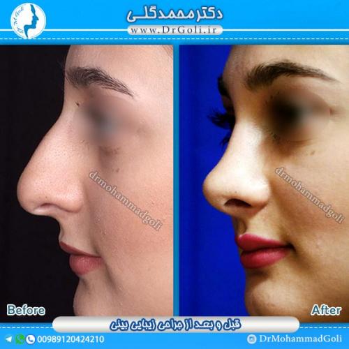 جراحی-زیبایی-بینی-12
