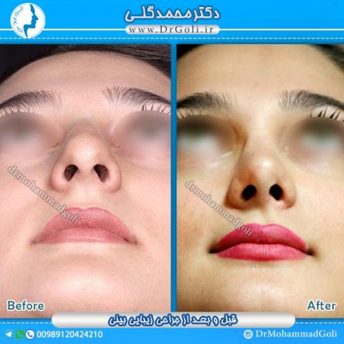 جراحی-زیبایی-بینی-13