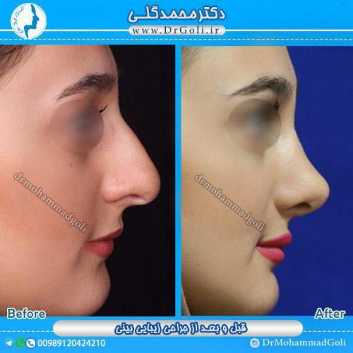 جراحی-زیبایی-بینی-14