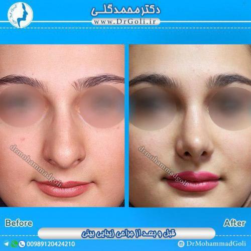 جراحی-زیبایی-بینی-15