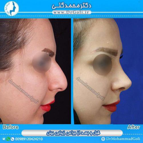 جراحی-زیبایی-بینی-16