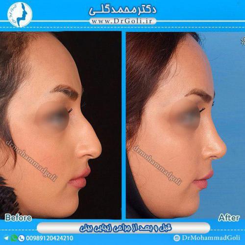 جراحی-زیبایی-بینی-17