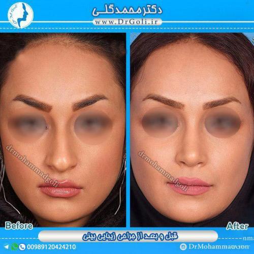جراحی-زیبایی-بینی-18