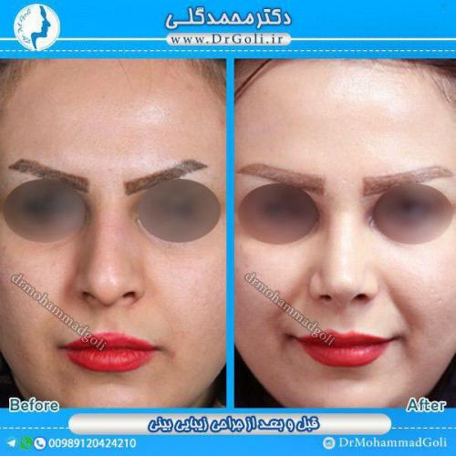 جراحی-زیبایی-بینی-19