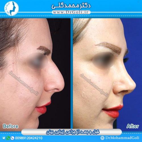 جراحی-زیبایی-بینی-2