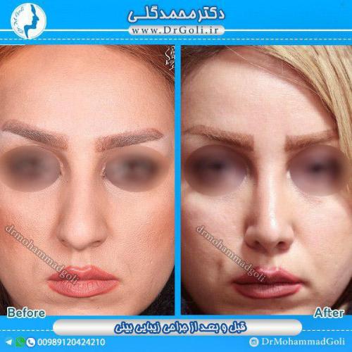 جراحی-زیبایی-بینی-20