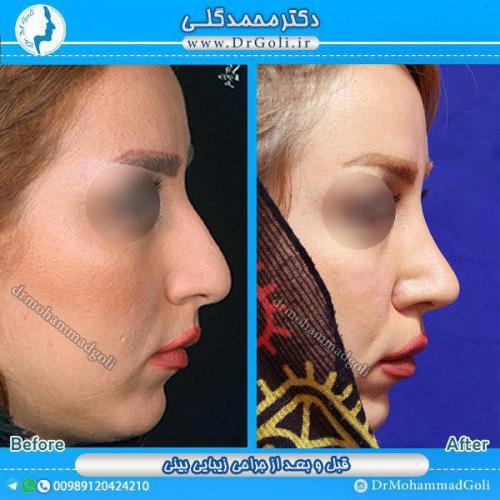 جراحی-زیبایی-بینی-21