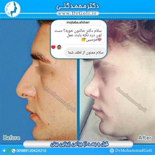جراحی-زیبایی-بینی-22