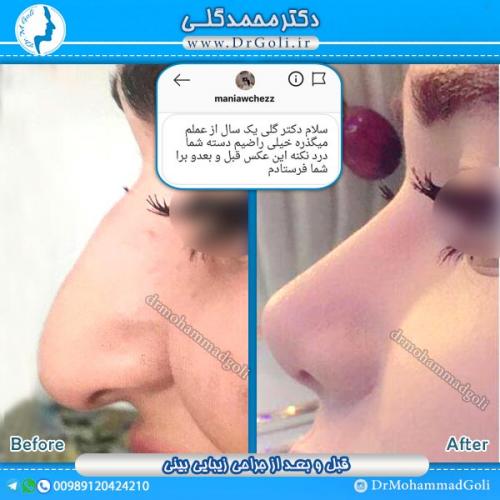 جراحی-زیبایی-بینی-25