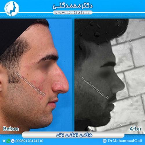 جراحی-زیبایی-بینی-27