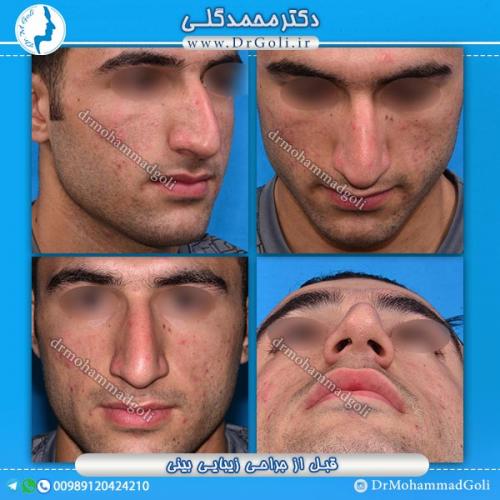 جراحی-زیبایی-بینی-28