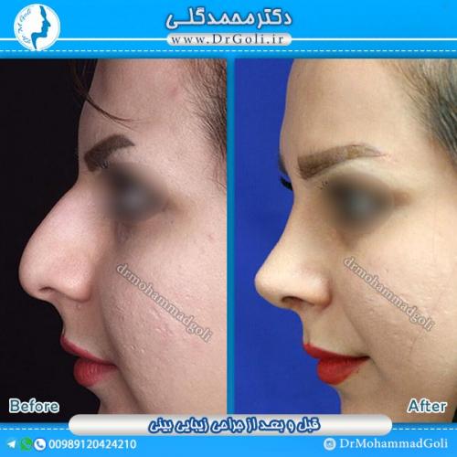 جراحی-زیبایی-بینی-3