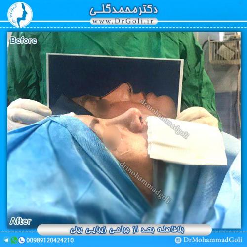 جراحی-زیبایی-بینی-30