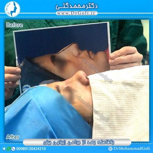 جراحی-زیبایی-بینی-31