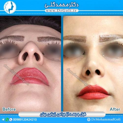 جراحی-زیبایی-بینی-4
