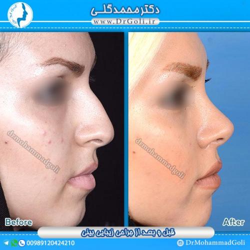 جراحی-زیبایی-بینی-5