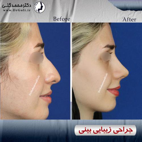 جراحی-زیبایی-بینی-501