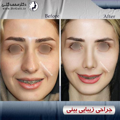 جراحی-زیبایی-بینی-508