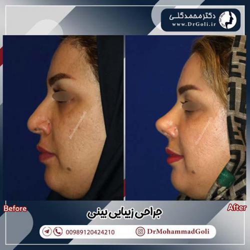 جراحی-زیبایی-بینی-589